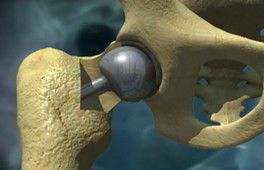 France Prothèses de hanche métalliques    un patient porte plainte