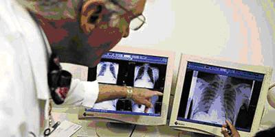 27 429 nouveaux cas de tuberculose enregistrés au Maroc en 2012